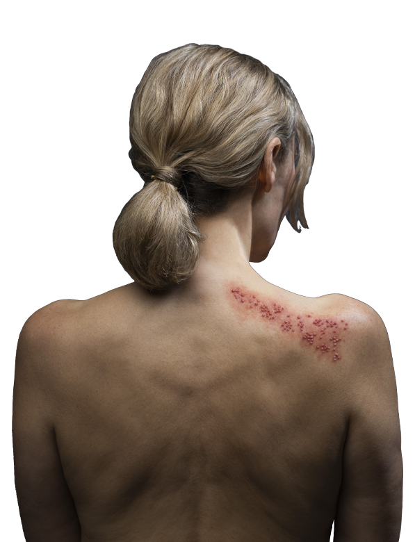 mulher herpes zoster de costas.